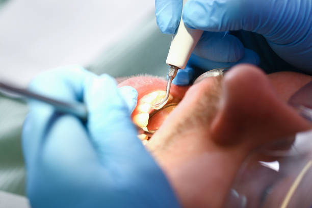 Best Knocked-Out Tooth (Avulsed Tooth) Treatment in Apopka, FL